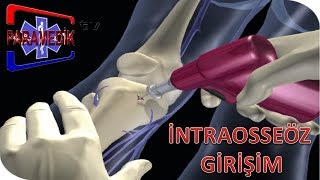 İntraosseöz Gi̇ri̇şi̇m