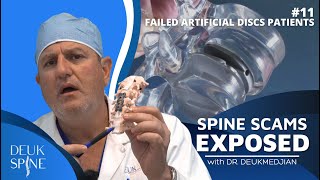 Spine Scams Exposes FAILED Artificial Disc Patients (Ep. 11)