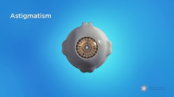 Astigmatism