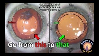 Removal of a phakic lens and then cataract surgery with a toric IOL