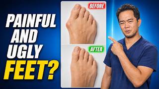 Fixing Ugly and Painful Feet Bunions without Surgery