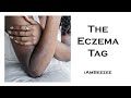 The Eczema Tag | IAmBeeZee