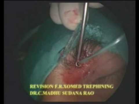 Revision Frontal Recess exploration with Frontal Trephining - Dr . Madhusudhan Rao