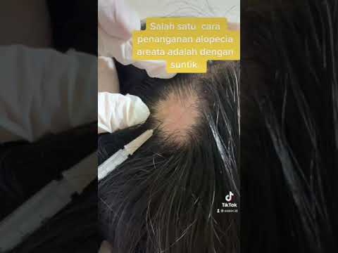 Video: 3 Cara Mengobati Alopecia