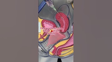 Thumbnail of 🤷🏻‍♀️🩸Menstrual cups & how they work #menstrualcup #periods #gynecologist #obgyn #menstrualcups