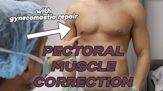 Pectoral Muscle Injury Correction with Liposuction and Fat Grafting, Gynecomastia Correction