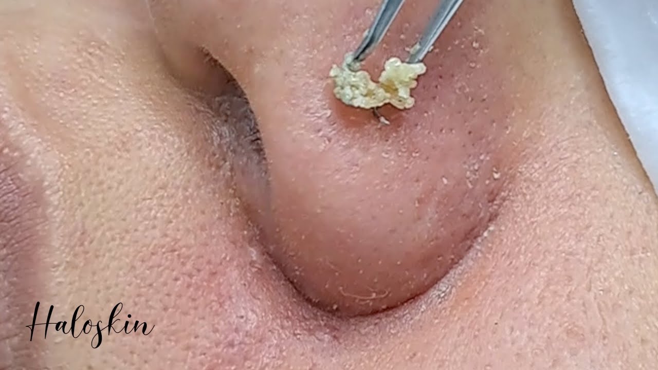 Relaxing and Satisfying CLEAN IT ALL : Halo Skin Hong Kong: Acne and Blackheads 黑頭粉刺