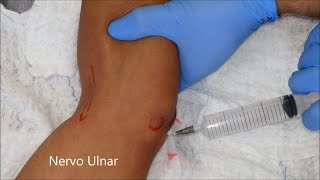 No bloqueio pé nervo do