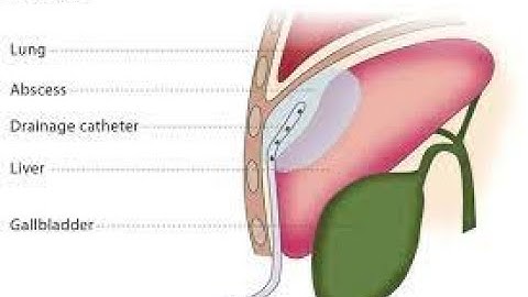 Image guided fluid collection drainage by catheter CPT code - simplify medical coding
