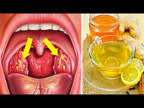 How to Cure Tonsillitis Fast and Naturally