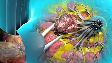 Learn about lumpectomy