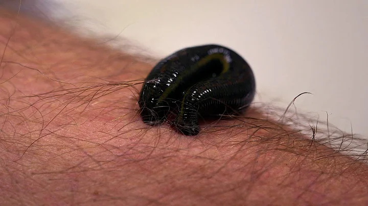 Michael Mosley is bitten by a leech - Infested! Li...