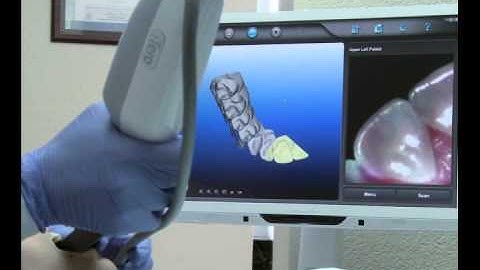 iTero patient video - Invisalign