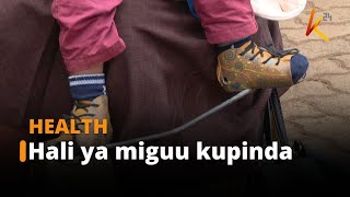 Watoto 2000 nchini huzaliwa na miguu iliyopinda, almaarufu 'clubfoot'