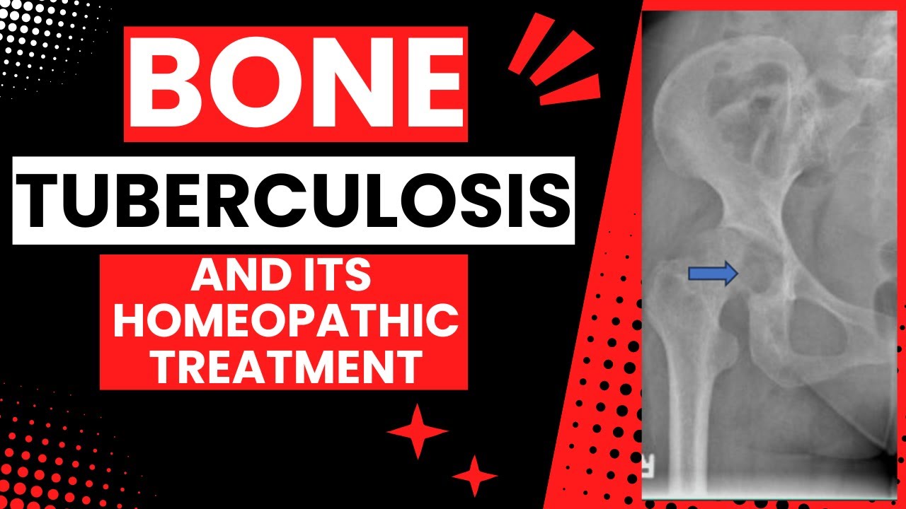 BONE TUBERCULOSIS || BONE TB || BEST HOMEOPATHIC MEDICINE FOR BONE TB !