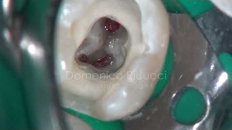 DRendo - Full (pulp chamber) pulpotomy in a mandibular second molar