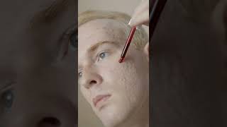 how to get rid of hormonal acne on chin naturally  THE ANDROGEN ATTACK #shorts Part 1