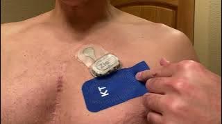 Zio Patch Heart Monitor Tricks