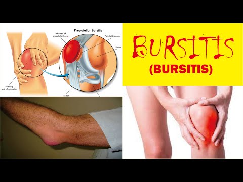 Video: Adakah bursitis muncul pada xray?