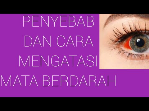 PENYEBAB DAN CARA MENGATASI MATA BERDARAH krishna healthy beauty channel#SHORTS