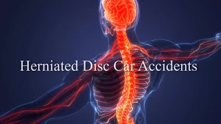 Herniated Disc Car Accidents: Spinal Injuries and Highway Accident Attorney in Southern California