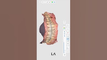 Record mandibular movement with medit i500 #digitaldentistry #prosthodontics