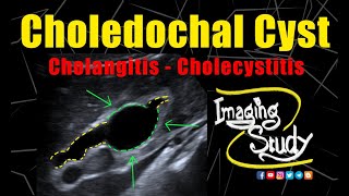 Choledochal Cyst With Cholangitis & Cholecysis Ultrasound Case 272