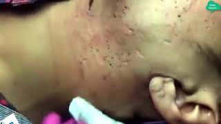 Blackheads Removal & Pimple Popping Videos 2020