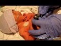 Physical Exam- 31 weeks gestation preterm infant