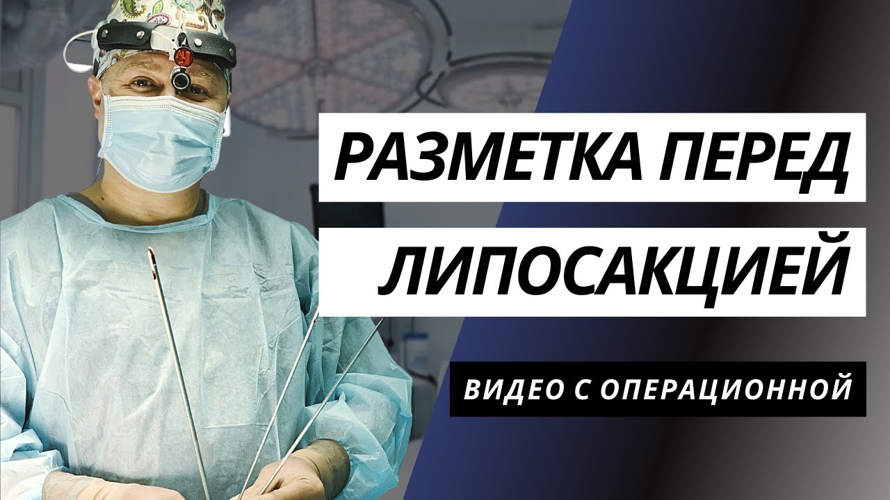 РАЗМЕТКА ПЕРЕД ЛИПОСАКЦИЕЙ ️ | ЛИПОСАКЦИЯ ЖИВОТА, БОКОВ И ФЛАНКОВ ...