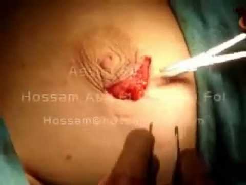 Video: Fibroadenoma Hos Menn