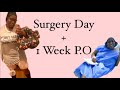 SURGERY DAY + 1 WEEK P.O | Dr. Argeny Mercedes | Plastic Surgery | Dominican Republic | TT, BBL,Lipo