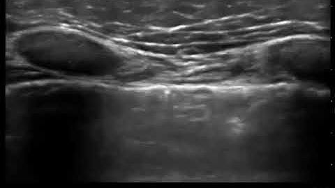 Lung Sliding with Linear Transducer