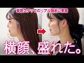 【二重あご】顔の脂肪吸引で垢抜けフェイスラインに♡カウンセリング〜1ヶ月後の変化までお見せします！｜脂肪吸引の母#272