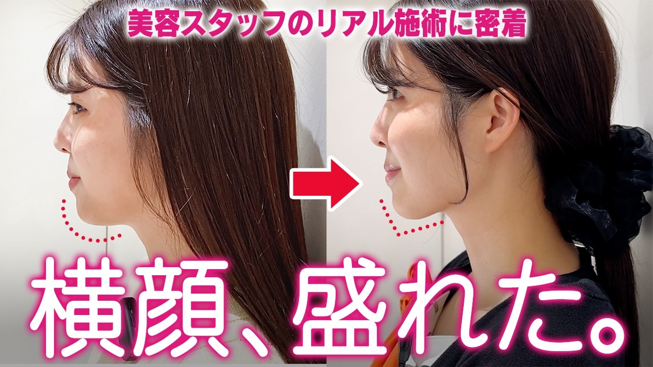 【二重あご】顔の脂肪吸引で垢抜けフェイスラインに♡カウンセリング〜1ヶ月後の変化までお見せします！｜脂肪吸引の母#272