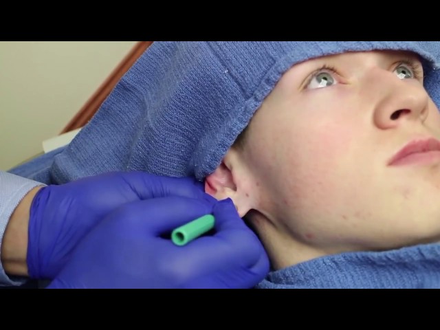 Gauge Torn Earlobe Repair San Diego CA