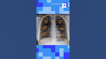 Chest X Ray Interpretation In 60 Seconds OSCE Guide UKMLA CPSA 