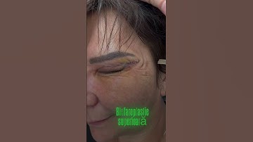 REZULTAT BLEFAROPLASTIE SUPERIOARĂ - 7 zile după operație [Clinica Doctor Levy București]
