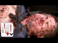 Deep fried turkey results in fourth degree burns  trauma  md tv