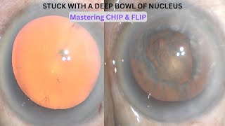 Mastering Chip & Flip technique in Phacoemulsification of soft cataracts screenshot 1