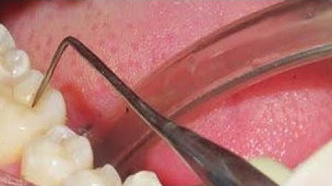 Methods Of Diagnosis of Dental Caries