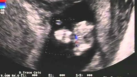 O que é síndrome do cordão umbilical curto Body Stalk?