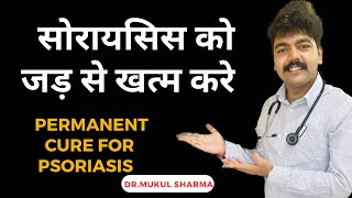 सोरायसिस को जड़ से खत्म करे | Permanent cure for psoriasis | soriasis ka ilaj | psoriasis doctor