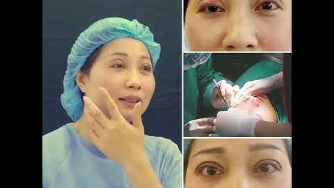 SỬA MÍ LỖI TẠI VIỆN THẨM MỸ Davinci