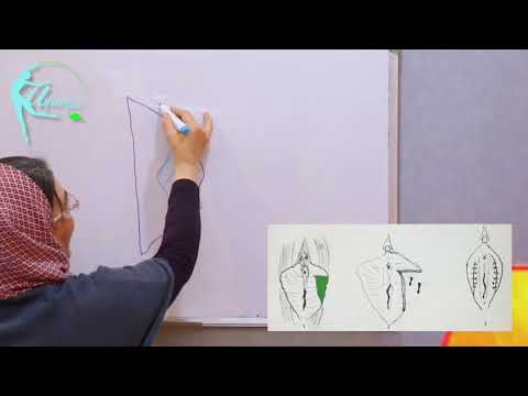 مراحل لابیاپلاستی 