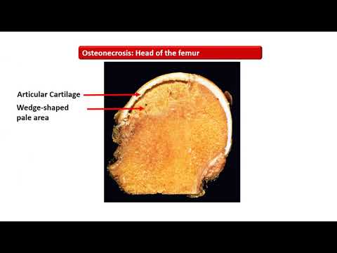 Video: Avascular Necrosis (Osteonecrosis): Pengobatan, Penyebab, Dan Banyak Lagi