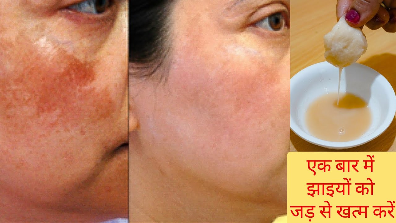 कितनी भी पुरानी झाइयां Pigmentation, जड़ से खत्म करें 100% रिजल्ट How to Remove Pigmentation?