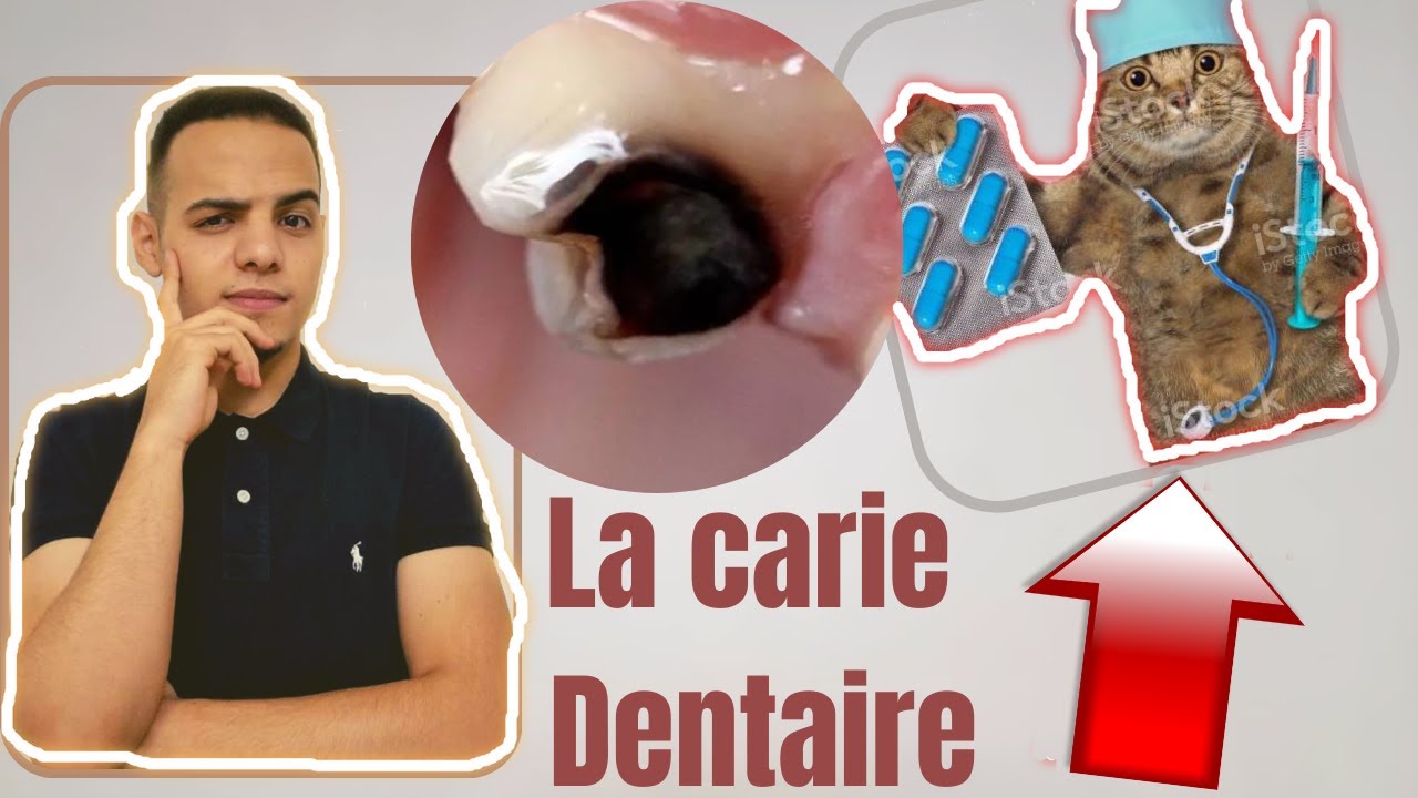 Y a pas aussi simple?! .. La CARIE  Dentaire  .