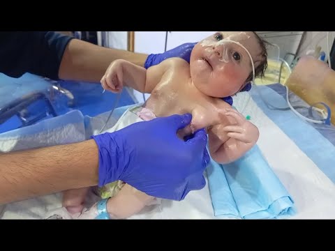 Brave Microcephaly Baby