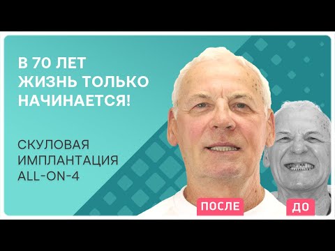 Скуловая имплантация all-on-4 в 70 лет: отзыв реального пациента
